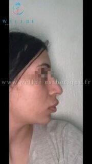 Résultat IMMÉDIAT 🔥 Rhinoplastie 🔥
————————————————————————
☎️Contactez-nous pour un Devis gratuit et personnalisé
WhatsApp 📲 + 216 52 869 696
📧 devis@wellbe-esthetique.fr
https://wellbe-esthetique.fr/
-————————————————————————
#chirurgieesthetique #plasticsurgery #chirurgieplastique #medecineesthetique #chirurgienesthetique #augmentationmammaire #rhinoplastie #liposuccion #tummytuck #bbl #facelift #botox #fillers #acidehyaluronique #avantapres #transformation #beauty #aesthetic #cosmeticsurgery #beforeandafter #plasticsurgeon #chirurgienplasticien #chirurgieesthetiqueparis #tunisie #paris #france#wellbechirurgieesthetique#wellbetunisie#wellbe