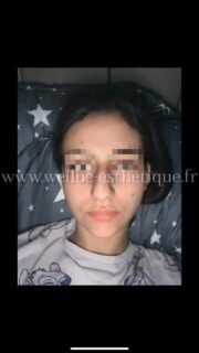 Résultat immédiat 🔥 Rhinoplastie 🔥
————————————————————————
☎️Contactez-nous pour un Devis gratuit et personnalisé
WhatsApp 📲 + 216 52 869 696
📧 devis@wellbe-esthetique.fr
https://wellbe-esthetique.fr/
-————————————————————————
#chirurgieesthetique #plasticsurgery #chirurgieplastique #medecineesthetique #chirurgienesthetique #augmentationmammaire #rhinoplastie #liposuccion #tummytuck #bbl #facelift #botox #fillers #acidehyaluronique #avantapres #transformation #beauty #aesthetic #cosmeticsurgery #beforeandafter #plasticsurgeon #chirurgienplasticien #chirurgieesthetiqueparis #tunisie #paris #france#wellbechirurgieesthetique#wellbetunisie#wellbe