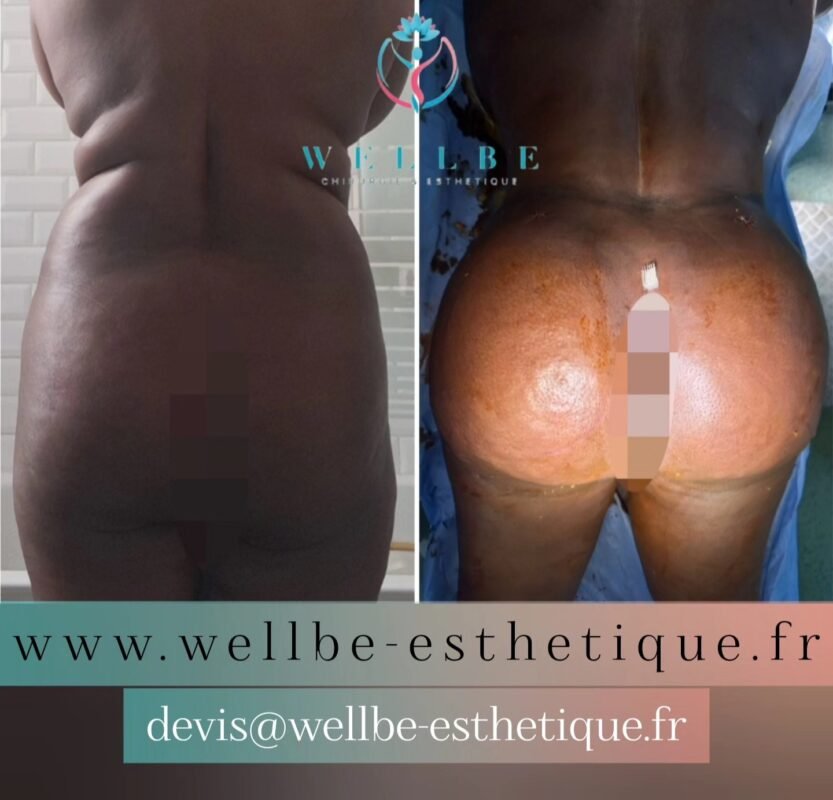Résultats Immédiat 🔥 Liposuccion plusieurs zones avec Lipofilling fesses ( BBL )🔥
————————————————————————
☎️Contactez-nous pour un Devis gratuit et personnalisé
WhatsApp 📲 + 216 52 869 696
📧 devis@wellbe-esthetique.fr
https://wellbe-esthetique.fr/
-————————————————————————
#wellbe#chirurgieesthetique #lipofilling#brazilianbutt #fesses #lipofillingfessierstunisie#bbl#lipofilling #chirurgie #lipofillingfessiers #abdominoplastie #abdominoplasty #liposuccion #beauty#lifting #mommymakeover #wellbechirurgieesthetique #santé #health #perfectlook