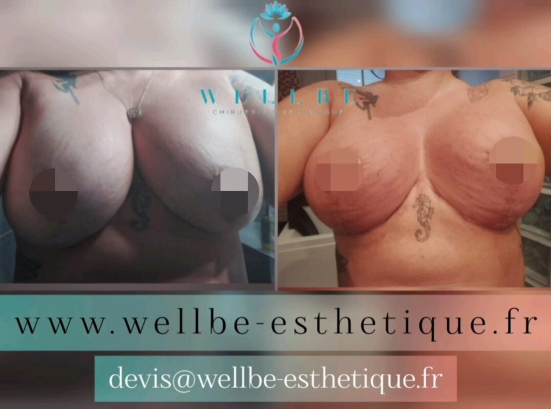 Résultats Immédiat 🔥Lifting mammaire avec changement prothèses 🔥
————————————————————————
☎️Contactez-nous pour un Devis gratuit et personnalisé
WhatsApp 📲 + 216 52 869 696
📧 devis@wellbe-esthetique.fr
https://wellbe-esthetique.fr/
-————————————————————————
#wellbe#chirurgieesthetique #lipofilling#brazilianbutt #fesses #lipofillingfessierstunisie#bbl#lipofilling #chirurgie #lipofillingfessiers #abdominoplastie #abdominoplasty #liposuccion #beauty#lifting #mommymakeover #wellbechirurgieesthetique #santé #health #perfectlook