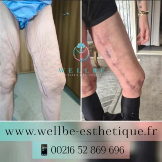 Résultats J + 30 🔥 Lifting cuisses 🔥
————————————————————————
☎️Contactez-nous pour un Devis gratuit et personnalisé
WhatsApp 📲 + 216 52 869 696
📧 devis@wellbe-esthetique.fr
https://wellbe-esthetique.fr/
-————————————————————————
#wellbe#chirurgieesthetique #lipofilling#brazilianbutt #fesses #lipofillingfessierstunisie#bbl#lipofilling #chirurgie #lipofillingfessiers #abdominoplastie #abdominoplasty #liposuccion #beauty#lifting #mommymakeover #wellbechirurgieesthetique #santé #health #perfectlook
