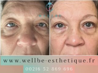 Résultats Immédiat 🔥 blépharoplastie supérieur 🔥
————————————————————————
☎️Contactez-nous pour un Devis gratuit et personnalisé
WhatsApp 📲 + 216 52 869 696
📧 devis@wellbe-esthetique.fr
https://wellbe-esthetique.fr/
-————————————————————————
#wellbe#chirurgieesthetique #lipofilling#brazilianbutt #fesses #lipofillingfessierstunisie#bbl#lipofilling #chirurgie #lipofillingfessiers #abdominoplastie #abdominoplasty #liposuccion #beauty#lifting #mommymakeover #wellbechirurgieesthetique #santé #health #perfectlook