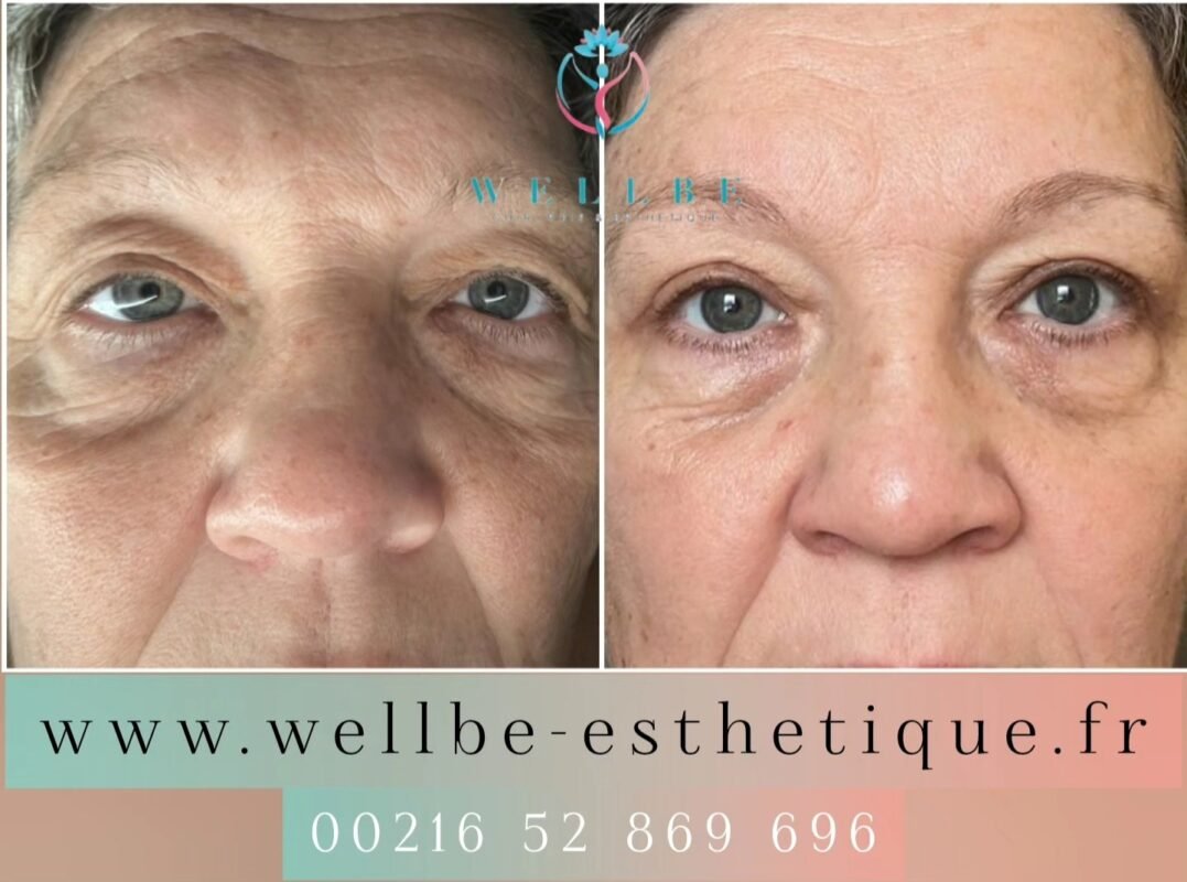 Résultats Immédiat 🔥 blépharoplastie supérieur 🔥
————————————————————————
☎️Contactez-nous pour un Devis gratuit et personnalisé
WhatsApp 📲 + 216 52 869 696
📧 devis@wellbe-esthetique.fr
https://wellbe-esthetique.fr/
-————————————————————————
#wellbe#chirurgieesthetique #lipofilling#brazilianbutt #fesses #lipofillingfessierstunisie#bbl#lipofilling #chirurgie #lipofillingfessiers #abdominoplastie #abdominoplasty #liposuccion #beauty#lifting #mommymakeover #wellbechirurgieesthetique #santé #health #perfectlook