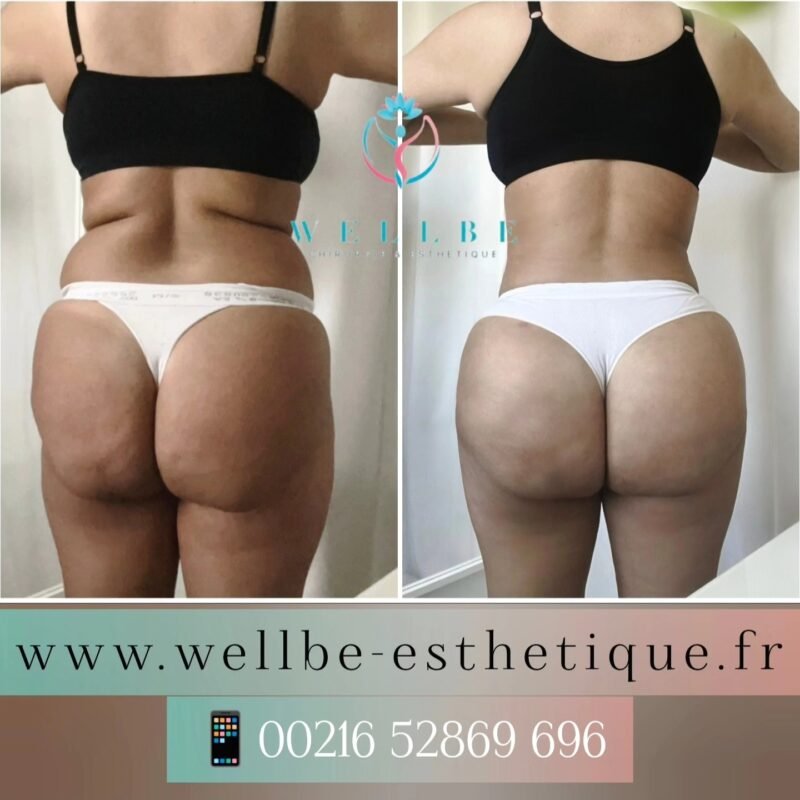 Résultats Immédiat 🔥 Liposuccion + BBL 🔥
————————————————————————
☎️Contactez-nous pour un Devis gratuit et personnalisé
WhatsApp 📲 + 216 52 869 696
📧 devis@wellbe-esthetique.fr
https://wellbe-esthetique.fr/
-————————————————————————
#wellbe#chirurgieesthetique #lipofilling#brazilianbutt #fesses #lipofillingfessierstunisie#bbl#lipofilling #chirurgie #lipofillingfessiers #abdominoplastie #abdominoplasty #liposuccion #beauty#lifting #mommymakeover #wellbechirurgieesthetique #santé #health #perfectlook