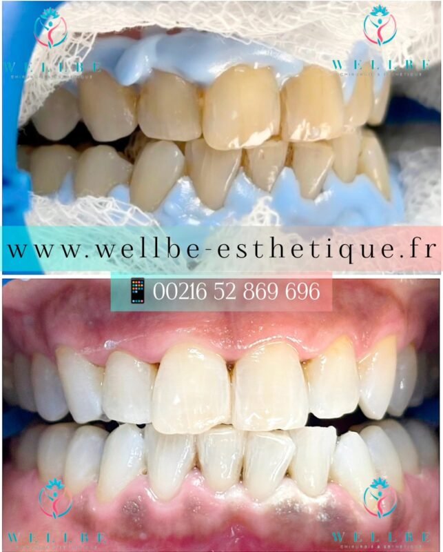 Résultats Immédiat 🔥Blanchiment dentaire 🔥
————————————————————————
☎️Contactez-nous pour un Devis gratuit et personnalisé
WhatsApp 📲 + 216 52 869 696
📧 devis@wellbe-esthetique.fr
https://wellbe-esthetique.fr/
-————————————————————————
#wellbe#chirurgieesthetique #lipofilling#brazilianbutt #fesses #lipofillingfessierstunisie#bbl#lipofilling #chirurgie #lipofillingfessiers #abdominoplastie #abdominoplasty #liposuccion #beauty#lifting #mommymakeover #wellbechirurgieesthetique #santé #health #perfectlook