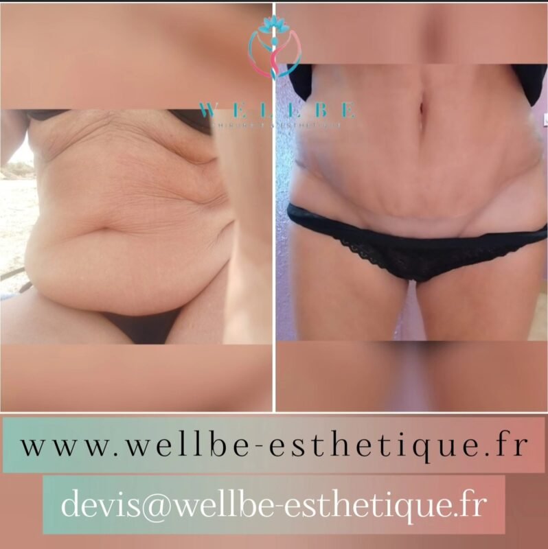 J + 30 🔥 Abdominoplastie 🔥
————————————————————————
☎️Contactez-nous pour un Devis gratuit et personnalisé
WhatsApp 📲 + 216 52 869 696
📧 devis@wellbe-esthetique.fr
https://wellbe-esthetique.fr/
-————————————————————————
#wellbe#chirurgieesthetique #lipofilling#brazilianbutt #fesses #lipofillingfessierstunisie#bbl#lipofilling #chirurgie #lipofillingfessiers #abdominoplastie #abdominoplasty #liposuccion #beauty#lifting #mommymakeover #wellbechirurgieesthetique #santé #health #perfectlook