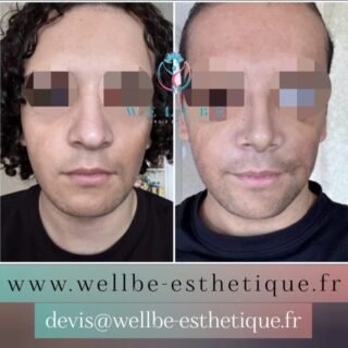 J + 7 🔥 Rhinoplastie 🔥
————————————————————————
☎️Contactez-nous pour un Devis gratuit et personnalisé
WhatsApp 📲 + 216 52 869 696
📧 devis@wellbe-esthetique.fr
https://wellbe-esthetique.fr/
-————————————————————————
#wellbe#chirurgieesthetique #lipofilling#brazilianbutt #fesses #lipofillingfessierstunisie#bbl#lipofilling #chirurgie #lipofillingfessiers #abdominoplastie #abdominoplasty #liposuccion #beauty#lifting #mommymakeover #wellbechirurgieesthetique #santé #health #perfectlook