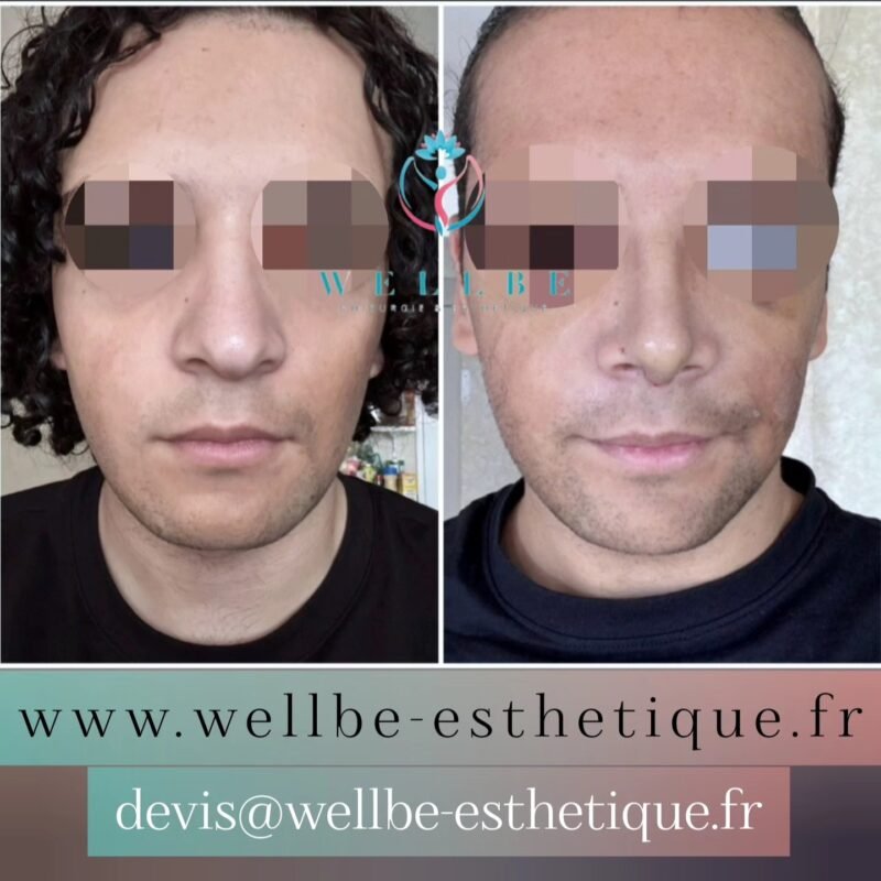 J + 7 🔥 Rhinoplastie 🔥
————————————————————————
☎️Contactez-nous pour un Devis gratuit et personnalisé
WhatsApp 📲 + 216 52 869 696
📧 devis@wellbe-esthetique.fr
https://wellbe-esthetique.fr/
-————————————————————————
#wellbe#chirurgieesthetique #lipofilling#brazilianbutt #fesses #lipofillingfessierstunisie#bbl#lipofilling #chirurgie #lipofillingfessiers #abdominoplastie #abdominoplasty #liposuccion #beauty#lifting #mommymakeover #wellbechirurgieesthetique #santé #health #perfectlook