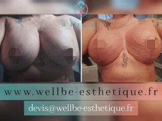 Résultats Immédiat 🔥 Lifting mammaire avec changement de prothèses 🔥
————————————————————————
☎️Contactez-nous pour un Devis gratuit et personnalisé
WhatsApp 📲 + 216 52 869 696
📧 devis@wellbe-esthetique.fr
https://wellbe-esthetique.fr/
-————————————————————————
#wellbe#chirurgieesthetique #lipofilling#brazilianbutt #fesses #lipofillingfessierstunisie#bbl#lipofilling #chirurgie #lipofillingfessiers #abdominoplastie #abdominoplasty #liposuccion #beauty#lifting #mommymakeover #wellbechirurgieesthetique #santé #health #perfectlook