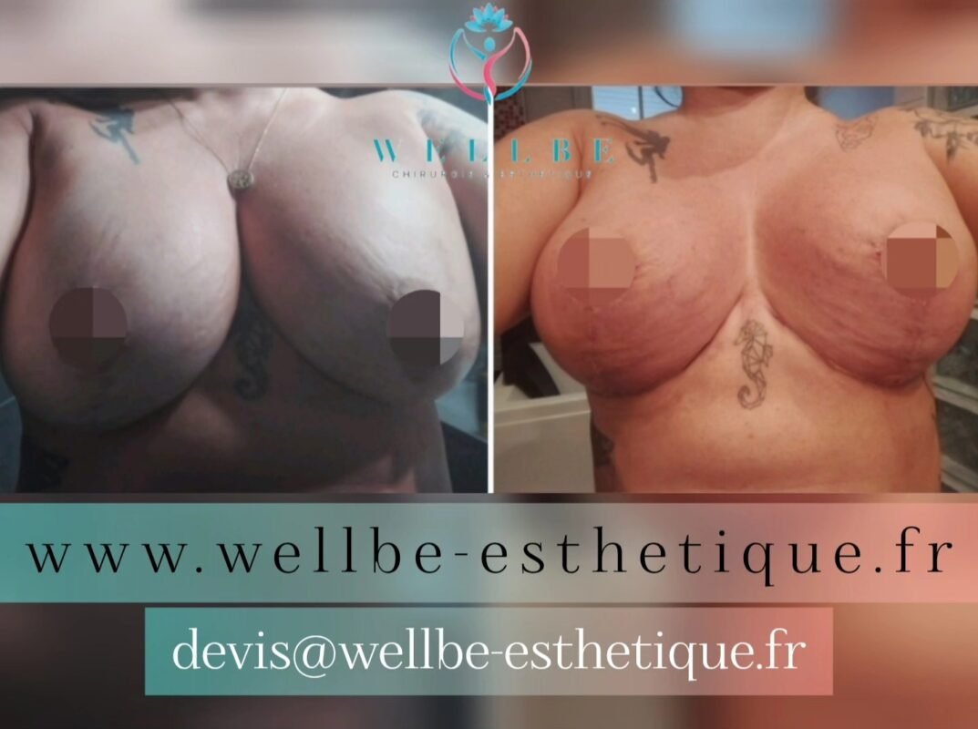 Résultats Immédiat 🔥 Lifting mammaire avec changement de prothèses 🔥
————————————————————————
☎️Contactez-nous pour un Devis gratuit et personnalisé
WhatsApp 📲 + 216 52 869 696
📧 devis@wellbe-esthetique.fr
https://wellbe-esthetique.fr/
-————————————————————————
#wellbe#chirurgieesthetique #lipofilling#brazilianbutt #fesses #lipofillingfessierstunisie#bbl#lipofilling #chirurgie #lipofillingfessiers #abdominoplastie #abdominoplasty #liposuccion #beauty#lifting #mommymakeover #wellbechirurgieesthetique #santé #health #perfectlook