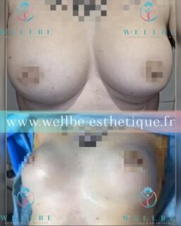 Résultats immédiat 🔥 Changement prothèses mammaires 🔥
————————————————————————
☎️Contactez-nous pour un Devis gratuit et personnalisé
WhatsApp 📲 + 216 52 869 696
📧 devis@wellbe-esthetique.fr
https://wellbe-esthetique.fr/
-————————————————————————
#wellbe#chirurgieesthetique #lipofilling#brazilianbutt #fesses #lipofillingfessierstunisie#bbl#lipofilling #chirurgie #lipofillingfessiers #abdominoplastie #abdominoplasty #liposuccion #beauty#lifting #mommymakeover #wellbechirurgieesthetique #santé #health #perfectlook