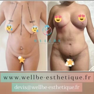 J + 30 🔥 Liposuccion plusieurs zones avec Abdominoplastie + Lifting mammaire avec prothèses 🔥
————————————————————————
☎️Contactez-nous pour un Devis gratuit et personnalisé
WhatsApp 📲 + 216 52 869 696
📧 devis@wellbe-esthetique.fr
https://wellbe-esthetique.fr/
-————————————————————————
#wellbe#chirurgieesthetique #lipofilling#brazilianbutt #fesses #lipofillingfessierstunisie#bbl#lipofilling #chirurgie #lipofillingfessiers #abdominoplastie #abdominoplasty #liposuccion #beauty#lifting #mommymakeover #wellbechirurgieesthetique #santé #health #perfectlook