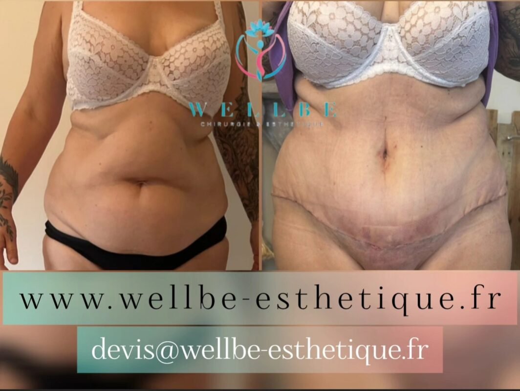 Résultats Immédiat 🔥 Liposuccion avec abdominoplastie 🔥
————————————————————————
☎️Contactez-nous pour un Devis gratuit et personnalisé
WhatsApp 📲 + 216 52 869 696
📧 devis@wellbe-esthetique.fr
https://wellbe-esthetique.fr/
-————————————————————————
#wellbe#chirurgieesthetique #lipofilling#brazilianbutt #fesses #lipofillingfessierstunisie#bbl#lipofilling #chirurgie #lipofillingfessiers #abdominoplastie #abdominoplasty #liposuccion #beauty#lifting #mommymakeover #wellbechirurgieesthetique #santé #health #perfectlook