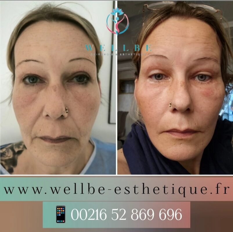 Résultats J + 30 🔥 Lifting cervico facial + blépharoplastie 🔥
————————————————————————
☎️Contactez-nous pour un Devis gratuit et personnalisé
WhatsApp 📲 + 216 52 869 696
📧 devis@wellbe-esthetique.fr
https://wellbe-esthetique.fr/
-————————————————————————
#wellbe#chirurgieesthetique #lipofilling#brazilianbutt #fesses #lipofillingfessierstunisie#bbl#lipofilling #chirurgie #lipofillingfessiers #abdominoplastie #abdominoplasty #liposuccion #beauty#lifting #mommymakeover #wellbechirurgieesthetique #santé #health #perfectlook
