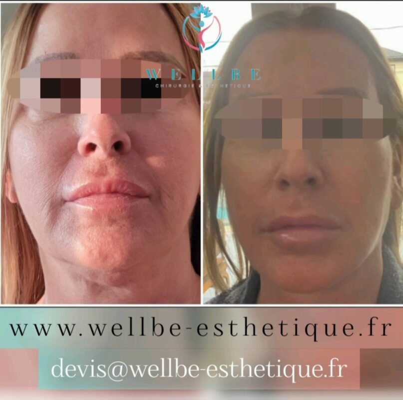 Résultats Immédiat 🔥 Lifting cervico facial 🔥
————————————————————————
☎️Contactez-nous pour un Devis gratuit et personnalisé
WhatsApp 📲 + 216 52 869 696
📧 devis@wellbe-esthetique.fr
https://wellbe-esthetique.fr/
-————————————————————————
#wellbe#chirurgieesthetique #lipofilling#brazilianbutt #fesses #lipofillingfessierstunisie#bbl#lipofilling #chirurgie #lipofillingfessiers #abdominoplastie #abdominoplasty #liposuccion #beauty#lifting #mommymakeover #wellbechirurgieesthetique #santé #health #perfectlook