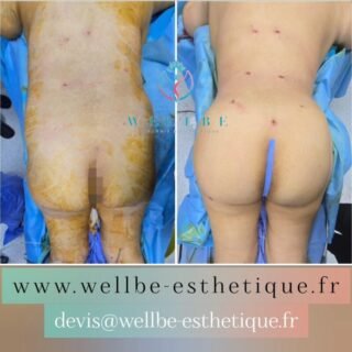 🔥 Liposuccion complète Vaser🔥
————————————————————————
☎️Contactez-nous pour un Devis gratuit et personnalisé
WhatsApp 📲 + 216 52 869 696
📧 devis@wellbe-esthetique.fr
https://wellbe-esthetique.fr/
-————————————————————————
#wellbe#chirurgieesthetique #lipofilling#brazilianbutt #fesses #lipofillingfessierstunisie#bbl#lipofilling #chirurgie #lipofillingfessiers #abdominoplastie #abdominoplasty #liposuccion #beauty#lifting #mommymakeover #wellbechirurgieesthetique #santé #health #perfectlook