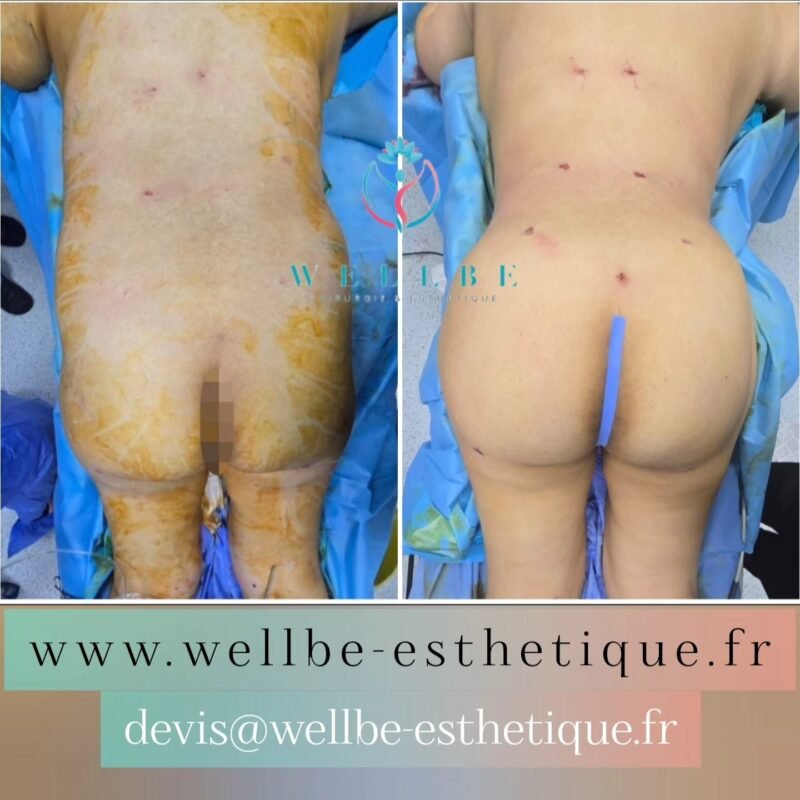 🔥 Liposuccion complète Vaser🔥
————————————————————————
☎️Contactez-nous pour un Devis gratuit et personnalisé
WhatsApp 📲 + 216 52 869 696
📧 devis@wellbe-esthetique.fr
https://wellbe-esthetique.fr/
-————————————————————————
#wellbe#chirurgieesthetique #lipofilling#brazilianbutt #fesses #lipofillingfessierstunisie#bbl#lipofilling #chirurgie #lipofillingfessiers #abdominoplastie #abdominoplasty #liposuccion #beauty#lifting #mommymakeover #wellbechirurgieesthetique #santé #health #perfectlook
