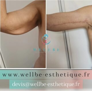 Résultats Immédiat 🔥Lifting bras 🔥
————————————————————————
☎️Contactez-nous pour un Devis gratuit et personnalisé
WhatsApp 📲 + 216 52 869 696
📧 devis@wellbe-esthetique.fr
https://wellbe-esthetique.fr/
-————————————————————————
#wellbe#chirurgieesthetique #lipofilling#brazilianbutt #fesses #lipofillingfessierstunisie#bbl#lipofilling #chirurgie #lipofillingfessiers #abdominoplastie #abdominoplasty #liposuccion #beauty#lifting #mommymakeover #wellbechirurgieesthetique #santé #health #perfectlook