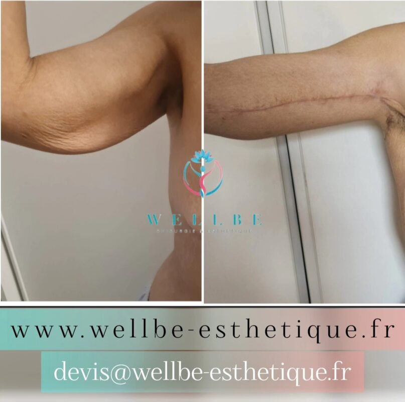 Résultats Immédiat 🔥Lifting bras 🔥
————————————————————————
☎️Contactez-nous pour un Devis gratuit et personnalisé
WhatsApp 📲 + 216 52 869 696
📧 devis@wellbe-esthetique.fr
https://wellbe-esthetique.fr/
-————————————————————————
#wellbe#chirurgieesthetique #lipofilling#brazilianbutt #fesses #lipofillingfessierstunisie#bbl#lipofilling #chirurgie #lipofillingfessiers #abdominoplastie #abdominoplasty #liposuccion #beauty#lifting #mommymakeover #wellbechirurgieesthetique #santé #health #perfectlook