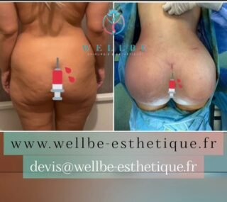 🔥 Lipofilling fesses (BBL)🔥
————————————————————————
☎️Contactez-nous pour un Devis gratuit et personnalisé
WhatsApp 📲 + 216 52 869 696
📧 devis@wellbe-esthetique.fr
https://wellbe-esthetique.fr/
-————————————————————————
#wellbe#chirurgieesthetique #lipofilling#brazilianbutt #fesses #lipofillingfessierstunisie#bbl#lipofilling #chirurgie #lipofillingfessiers #abdominoplastie #abdominoplasty #liposuccion #beauty#lifting #mommymakeover #wellbechirurgieesthetique #santé #health #perfectlook