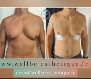 🔥 Liposuccion pectoraux 🔥
————————————————————————
☎️Contactez-nous pour un Devis gratuit et personnalisé
WhatsApp 📲 + 216 52 869 696
📧 devis@wellbe-esthetique.fr
https://wellbe-esthetique.fr/
-————————————————————————
#wellbe#chirurgieesthetique #lipofilling#brazilianbutt #fesses #lipofillingfessierstunisie#bbl#lipofilling #chirurgie #lipofillingfessiers #abdominoplastie #abdominoplasty #liposuccion #beauty#lifting #mommymakeover #wellbechirurgieesthetique #santé #health #perfectlook