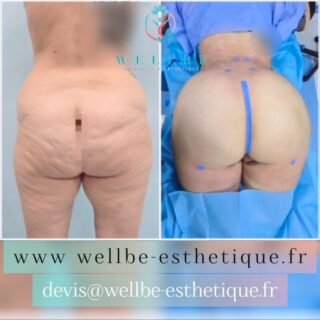 Résultats Immédiat 🔥 Liposculpture 🔥
————————————————————————
☎️Contactez-nous pour un Devis gratuit et personnalisé
WhatsApp 📲 + 216 52 869 696
📧 devis@wellbe-esthetique.fr
https://wellbe-esthetique.fr/
-————————————————————————
#wellbe#chirurgieesthetique #lipofilling#brazilianbutt #fesses #lipofillingfessierstunisie#bbl#lipofilling #chirurgie #lipofillingfessiers #abdominoplastie #abdominoplasty #liposuccion #beauty#lifting #mommymakeover #wellbechirurgieesthetique #santé #health #perfectlook