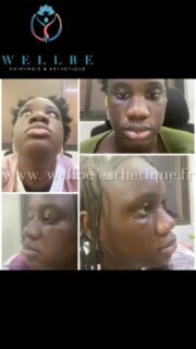 Résultat immédiat 🔥 Rhinoplastie Ethnique 🔥
————————————————————————
☎️Contactez-nous pour un Devis gratuit et personnalisé
WhatsApp 📲 + 216 52 869 696
📧 devis@wellbe-esthetique.fr
https://wellbe-esthetique.fr/
-————————————————————————
#chirurgieesthetique #plasticsurgery #chirurgieplastique #medecineesthetique #chirurgienesthetique