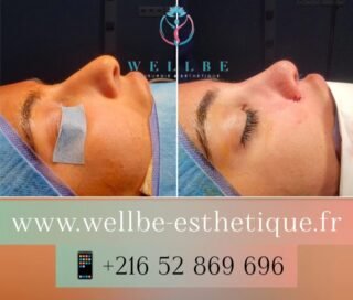 Résultat IMMÉDIAT 🔥 Rhinoplastie 🔥
————————————————————————
☎️Contactez-nous pour un Devis gratuit et personnalisé
WhatsApp 📲 + 216 52 869 696
📧 devis@wellbe-esthetique.fr
https://wellbe-esthetique.fr/
-————————————————————————
#chirurgieesthetique #plasticsurgery #chirurgieplastique #medecineesthetique #chirurgienesthetique #augmentationmammaire #rhinoplastie #liposuccion #tummytuck #bbl #facelift #botox #fillers #acidehyaluronique #avantapres #transformation #beauty #aesthetic #cosmeticsurgery #beforeandafter #plasticsurgeon #chirurgienplasticien #chirurgieesthetiqueparis #tunisie #paris #france#wellbechirurgieesthetique#wellbetunisie#wellbe