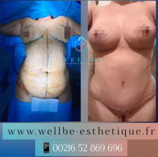 Résultats Immédiat 🔥 Lifting mammaire sans prothèses + Lifting bras + Abdominoplastie 🔥
————————————————————————
☎️Contactez-nous pour un Devis gratuit et personnalisé
WhatsApp 📲 + 216 52 869 696
📧 devis@wellbe-esthetique.fr
https://wellbe-esthetique.fr/
-————————————————————————
#wellbe#chirurgieesthetique #lipofilling#brazilianbutt #fesses #lipofillingfessierstunisie#bbl#lipofilling #chirurgie #lipofillingfessiers #abdominoplastie #abdominoplasty #liposuccion #beauty#lifting #mommymakeover #wellbechirurgieesthetique #santé #health #perfectlook