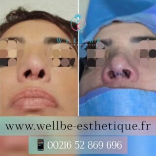 Résultats Immédiat 🔥 Rhinoplastie secondaire 🔥
————————————————————————
☎️Contactez-nous pour un Devis gratuit et personnalisé
WhatsApp 📲 + 216 52 869 696
📧 devis@wellbe-esthetique.fr
https://wellbe-esthetique.fr/
-————————————————————————
#wellbe#chirurgieesthetique #lipofilling#brazilianbutt #fesses #lipofillingfessierstunisie#bbl#lipofilling #chirurgie #lipofillingfessiers #abdominoplastie #abdominoplasty #liposuccion #beauty#lifting #mommymakeover #wellbechirurgieesthetique #santé #health #perfectlook