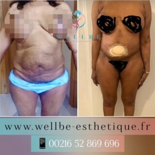 Résultats Immédiat 🔥 Liposuccion Vaser avec Abdominoplastie 🔥
————————————————————————
☎️Contactez-nous pour un Devis gratuit et personnalisé
WhatsApp 📲 + 216 52 869 696
📧 devis@wellbe-esthetique.fr
https://wellbe-esthetique.fr/
-————————————————————————
#wellbe#chirurgieesthetique #lipofilling#brazilianbutt #fesses #lipofillingfessierstunisie#bbl#lipofilling #chirurgie #lipofillingfessiers #abdominoplastie #abdominoplasty #liposuccion #beauty#lifting #mommymakeover #wellbechirurgieesthetique #santé #health #perfectlook