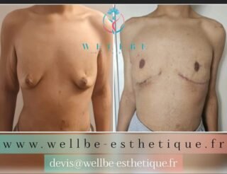 Résultats Immédiat 🔥Gynécomastie 🔥
————————————————————————
☎️Contactez-nous pour un Devis gratuit et personnalisé
WhatsApp 📲 + 216 52 869 696
📧 devis@wellbe-esthetique.fr
https://wellbe-esthetique.fr/
-————————————————————————
#wellbe#chirurgieesthetique #lipofilling#brazilianbutt #fesses #lipofillingfessierstunisie#bbl#lipofilling #chirurgie #lipofillingfessiers #abdominoplastie #abdominoplasty #liposuccion #beauty#lifting #mommymakeover #wellbechirurgieesthetique #santé #health #perfectlook