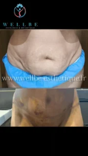Partie 2🔥 Liposuccion avec Abdominoplastie 🔥Dr Riadh el fatmi
————————————————————————
☎️Contactez-nous pour un Devis gratuit et personnalisé
WhatsApp 📲 + 216 52 869 696
📧 devis@wellbe-esthetique.fr
https://wellbe-esthetique.fr/
-————————————————————————
#chirurgieesthetique #plasticsurgery #chirurgieplastique #medecineesthetique #chirurgienesthetique
