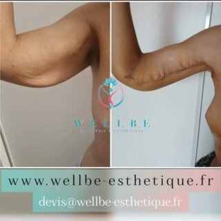 Résultats Immédiat 🔥 Lifting bras 🔥
————————————————————————
☎️Contactez-nous pour un Devis gratuit et personnalisé
WhatsApp 📲 + 216 52 869 696
📧 devis@wellbe-esthetique.fr
https://wellbe-esthetique.fr/
-————————————————————————
#wellbe#chirurgieesthetique #lipofilling#brazilianbutt #fesses #lipofillingfessierstunisie#bbl#lipofilling #chirurgie #lipofillingfessiers #abdominoplastie #abdominoplasty #liposuccion #beauty#lifting #mommymakeover #wellbechirurgieesthetique #santé #health #perfectlook