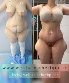J+30 🔥 Liposuccion plusieurs zones avec Abdominoplastie 🔥
————————————————————————
☎️Contactez-nous pour un Devis gratuit et personnalisé
WhatsApp 📲 + 216 52 869 696
📧 devis@wellbe-esthetique.fr
https://wellbe-esthetique.fr/
-————————————————————————
#wellbe#chirurgieesthetique #lipofilling#brazilianbutt #fesses #lipofillingfessierstunisie#bbl#lipofilling #chirurgie #lipofillingfessiers #abdominoplastie #abdominoplasty #liposuccion #beauty#lifting #mommymakeover #wellbechirurgieesthetique #santé #health #perfectlook