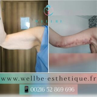 Résultats J + 30 🔥 Lifting bras 🔥
————————————————————————
☎️Contactez-nous pour un Devis gratuit et personnalisé
WhatsApp 📲 + 216 52 869 696
📧 devis@wellbe-esthetique.fr
https://wellbe-esthetique.fr/
-————————————————————————
#wellbe#chirurgieesthetique #lipofilling#brazilianbutt #fesses  #lipofillingfessierstunisie#bbl#lipofilling #chirurgie #lipofillingfessiers #abdominoplastie #abdominoplasty #liposuccion #beauty#lifting #mommymakeover #wellbechirurgieesthetique #santé #health #perfectlook