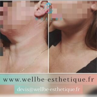 Résultats Immédiat 🔥Lifting cou🔥
————————————————————————
☎️Contactez-nous pour un Devis gratuit et personnalisé
WhatsApp 📲 + 216 52 869 696
📧 devis@wellbe-esthetique.fr
https://wellbe-esthetique.fr/
-————————————————————————
#wellbe#chirurgieesthetique #lipofilling#brazilianbutt #fesses  #lipofillingfessierstunisie#bbl#lipofilling #chirurgie #lipofillingfessiers #abdominoplastie #abdominoplasty #liposuccion #beauty#lifting #mommymakeover #wellbechirurgieesthetique #santé #health #perfectlook