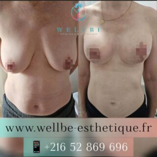 Résultat IMMÉDIAT 🔥Lifting mammaire avec prothèses 🔥
————————————————————————
☎️Contactez-nous pour un Devis gratuit et personnalisé
WhatsApp 📲 + 216 52 869 696
📧 devis@wellbe-esthetique.fr
https://wellbe-esthetique.fr/
-————————————————————————
#chirurgieesthetique #plasticsurgery #chirurgieplastique #medecineesthetique #chirurgienesthetique #augmentationmammaire #rhinoplastie #liposuccion #tummytuck #bbl #facelift #botox #fillers #acidehyaluronique #avantapres #transformation #beauty #aesthetic #cosmeticsurgery #beforeandafter #plasticsurgeon #chirurgienplasticien #chirurgieesthetiqueparis #tunisie #paris #france#wellbechirurgieesthetique#wellbetunisie#wellbe