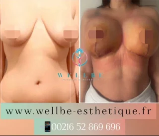 Résultats Immédiat 🔥 Lifting mammaire avec prothèses 🔥
————————————————————————
☎️Contactez-nous pour un Devis gratuit et personnalisé
WhatsApp 📲 + 216 52 869 696
📧 devis@wellbe-esthetique.fr
https://wellbe-esthetique.fr/
-————————————————————————
#wellbe#chirurgieesthetique #lipofilling#brazilianbutt #fesses #lipofillingfessierstunisie#bbl#lipofilling #chirurgie #lipofillingfessiers #abdominoplastie #abdominoplasty #liposuccion #beauty#lifting #mommymakeover #wellbechirurgieesthetique #santé #health #perfectlook