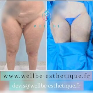 Résultats Immédiat 🔥Lifting cuisses🔥
————————————————————————
☎️Contactez-nous pour un Devis gratuit et personnalisé
WhatsApp 📲 + 216 52 869 696
📧 devis@wellbe-esthetique.fr
https://wellbe-esthetique.fr/
-————————————————————————
#wellbe#chirurgieesthetique #lipofilling#brazilianbutt #fesses  #lipofillingfessierstunisie#bbl#lipofilling #chirurgie #lipofillingfessiers #abdominoplastie #abdominoplasty #liposuccion #beauty#lifting #mommymakeover #wellbechirurgieesthetique #santé #health #perfectlook