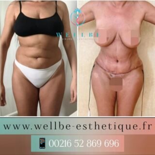 Résultats Immédiat 🔥 Liposuccion avec Abdominoplastie 🔥
————————————————————————
☎️Contactez-nous pour un Devis gratuit et personnalisé
WhatsApp 📲 + 216 52 869 696
📧 devis@wellbe-esthetique.fr
https://wellbe-esthetique.fr/
-————————————————————————
#wellbe#chirurgieesthetique #lipofilling#brazilianbutt #fesses  #lipofillingfessierstunisie#bbl#lipofilling #chirurgie #lipofillingfessiers #abdominoplastie #abdominoplasty #liposuccion #beauty#lifting #mommymakeover #wellbechirurgieesthetique #santé #health #perfectlook