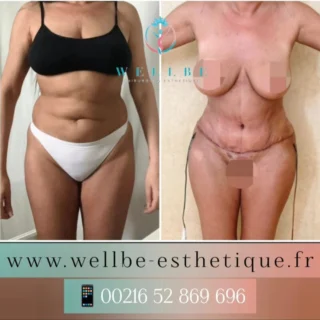Résultats Immédiat 🔥 Liposuccion avec Abdominoplastie 🔥
————————————————————————
☎️Contactez-nous pour un Devis gratuit et personnalisé
WhatsApp 📲 + 216 52 869 696
📧 devis@wellbe-esthetique.fr
https://wellbe-esthetique.fr/
-————————————————————————
#wellbe#chirurgieesthetique #lipofilling#brazilianbutt #fesses #lipofillingfessierstunisie#bbl#lipofilling #chirurgie #lipofillingfessiers #abdominoplastie #abdominoplasty #liposuccion #beauty#lifting #mommymakeover #wellbechirurgieesthetique #santé #health #perfectlook