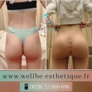 Résultats Immédiat 🔥 Prothèses fessier 300cc🔥
————————————————————————
☎️Contactez-nous pour un Devis gratuit et personnalisé
WhatsApp 📲 + 216 52 869 696
📧 devis@wellbe-esthetique.fr
https://wellbe-esthetique.fr/
-————————————————————————
#wellbe#chirurgieesthetique #lipofilling#brazilianbutt #fesses  #lipofillingfessierstunisie#bbl#lipofilling #chirurgie #lipofillingfessiers #abdominoplastie #abdominoplasty #liposuccion #beauty#lifting #mommymakeover #wellbechirurgieesthetique #santé #health #perfectlook