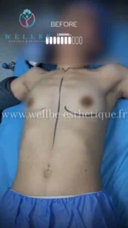 Résultat immédiat 🔥 Augmentation mammaire 🔥
———————————————————————
☎️Contactez-nous pour un Devis gratuit et personnalisé
WhatsApp 📲 + 216 52 869 696
📧 devis@wellbe-esthetique.fr
https://wellbe-esthetique.fr/
-————————————————————————
#chirurgieesthetique #plasticsurgery #chirurgieplastique #medecineesthetique #chirurgienesthetique