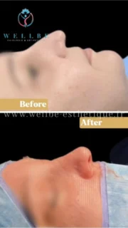 Résultat immédiat 🔥 Rhinoplastie 🔥
———————————————————————
☎️Contactez-nous pour un Devis gratuit et personnalisé
WhatsApp 📲 + 216 52 869 696
📧 devis@wellbe-esthetique.fr
https://wellbe-esthetique.fr/
-————————————————————————
#chirurgieesthetique #plasticsurgery #chirurgieplastique #medecineesthetique #chirurgienesthetique