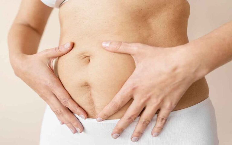 Abdominoplastie après césarienne