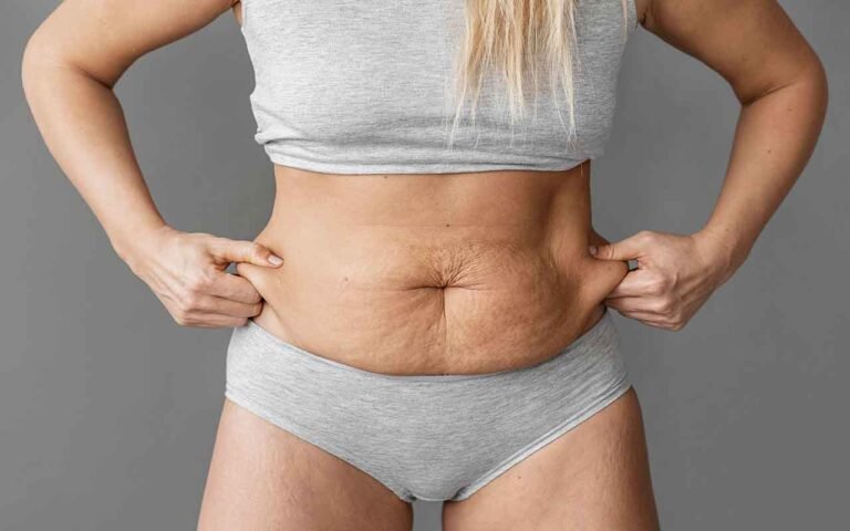 Que peut améliorer une abdominoplastie sur la silhouette