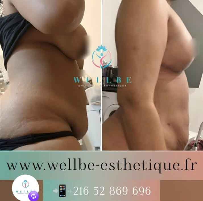 avant apres liposuccion vaser