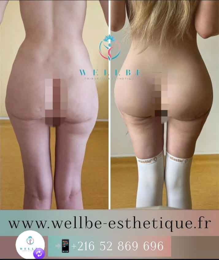 bbl wellbe avant apres