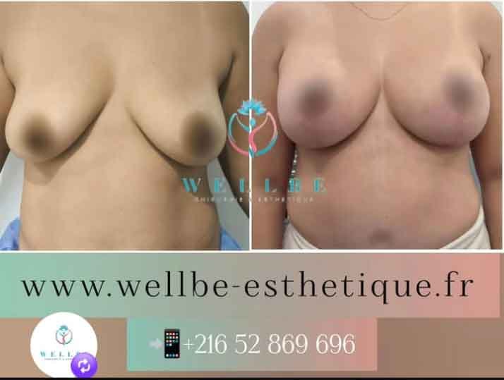 lifting mammaire simple
